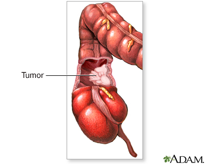 Colon Resection Soft Diet