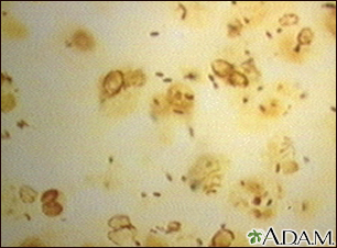 Legionnaire disease - organism legionella