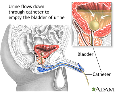 Bladder catheterization - male