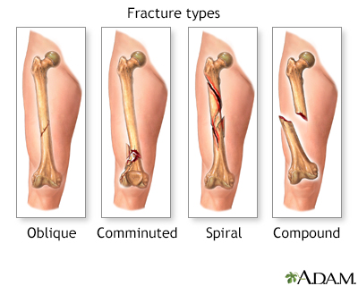 Fracture types (1)
