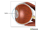 Cataract surgery - series - Normal anatomy