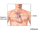Heart transplant - series