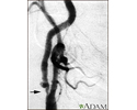 Carotid stenosis - X-ray of the right artery