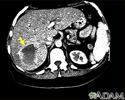 Hemangioma - CT scan