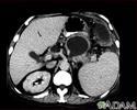Pancreatic pseudocyst - CT scan