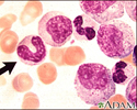 Chronic myelocytic leukemia - microscopic view