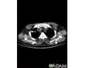 Pulmonary nodule, solitary - CT scan