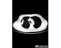 Lung with squamous cell cancer - CT scan