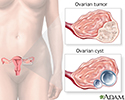 Ovarian growth worries