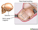 Fetal head molding