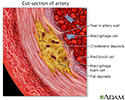 Enlarged view of atherosclerosis