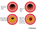 Developmental process of atherosclerosis
