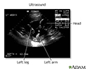 Ultrasound, normal fetus - ventricles of brain