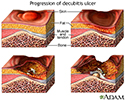 Progression of a decubitis ulcer