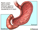 Location of peptic ulcers