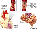 Plaque buildup in arteries