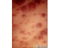 Acute monocytic leukemia - skin