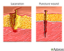 Laceration versus puncture wound