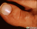 White nail syndrome