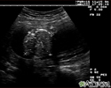 Ultrasound, normal fetus - abdomen measurements