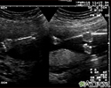 Ultrasound, normal fetus - arms and legs