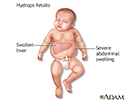 Hydrops fetalis