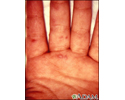 Hand, foot, and mouth disease on the hand