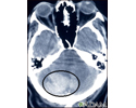 Intracerebellar hemorrhage - CT scan