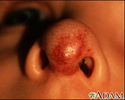 Hemangioma on the face (nose)