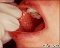 Lichen planus on the oral mucosa