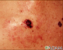 Skin cancer - close-up of level IV melanoma