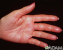 Herpes zoster (shingles) on the hand