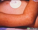 Rocky mountain spotted fever, petechial rash