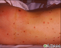 Meningococcal lesions on the back