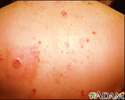 Multiple Basal cell cancer due to x-ray therapy for acne