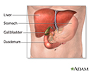 Gallbladder removal - Series