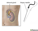 Adrenal gland biopsy