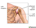 Shoulder joint inflammation