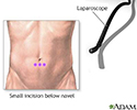 Incision for abdominal laparoscopy