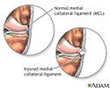 Torn medial collateral ligament