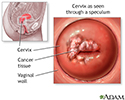Pap smears and cervical cancer