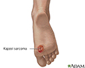 Kaposi sarcoma on foot