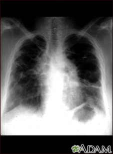 Sarcoid, stage IV - chest x-ray