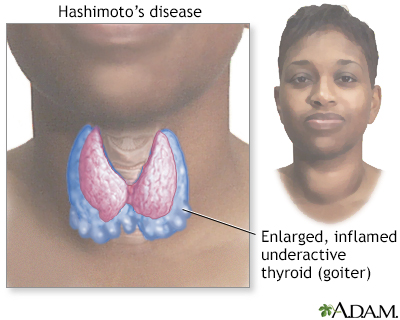 Hashimoto's disease (chronic thyroiditis)