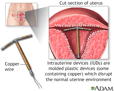 Intrauterine device