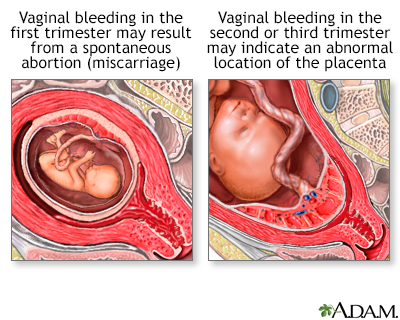 Vaginal bleeding during pregnancy