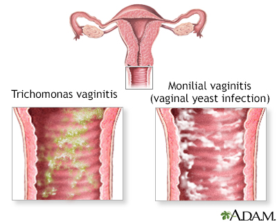 Causes of vaginal itching