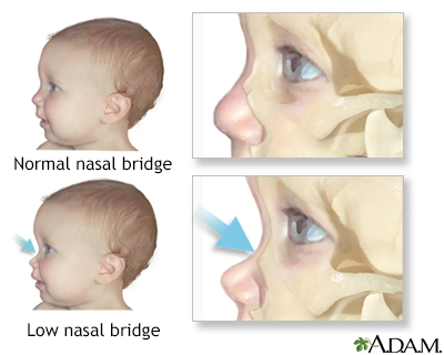 Low nasal bridge