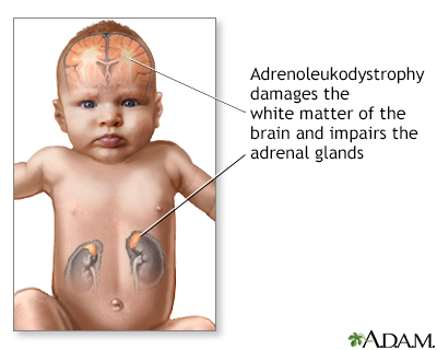 Neonatal adrenoleukodystrophy