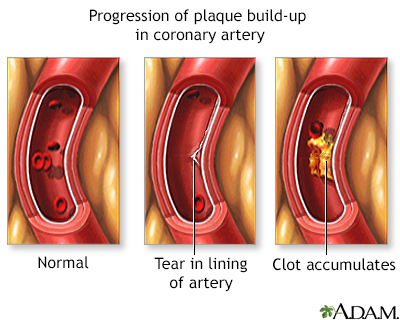 Progressive build-up of plaque in coronary artery